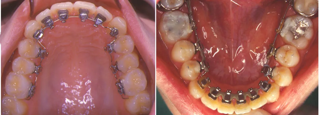 Lingual Braces